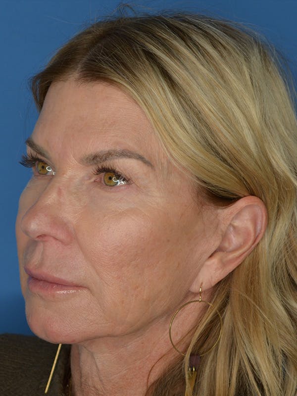 Facelift Before & After Gallery - Patient 115416 - Image 3