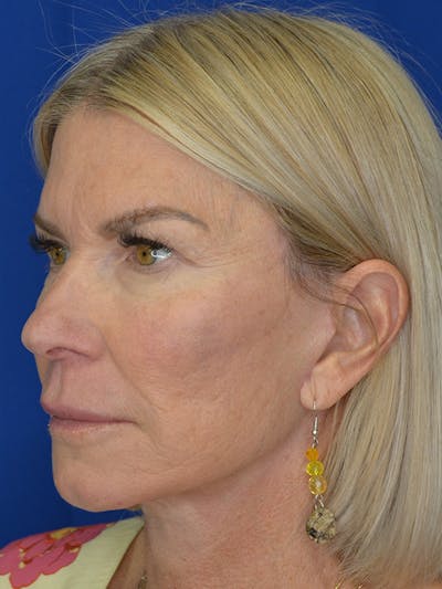 Facelift Before & After Gallery - Patient 115416 - Image 4