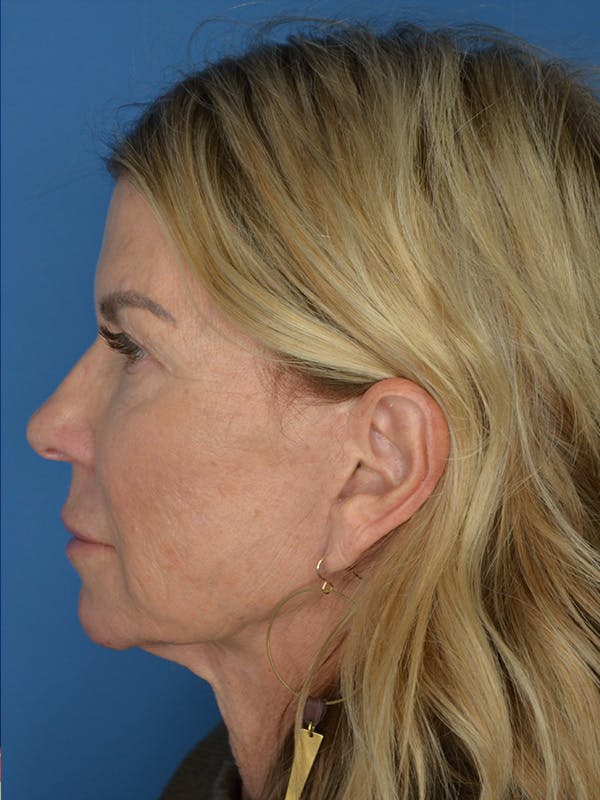 Facelift Before & After Gallery - Patient 115416 - Image 5