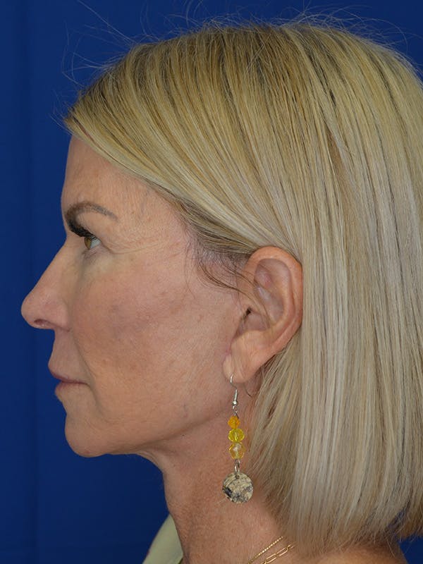Facelift Before & After Gallery - Patient 115416 - Image 6