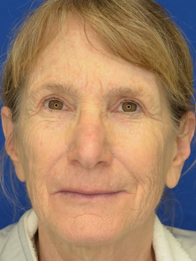 Facelift Before & After Gallery - Patient 413052 - Image 1