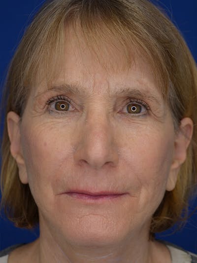Facelift Before & After Gallery - Patient 413052 - Image 2