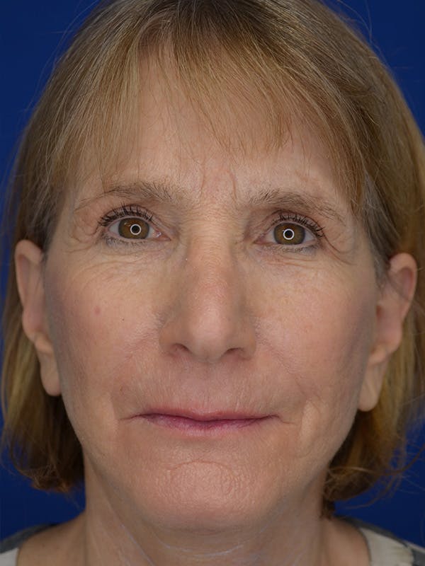 Facelift Before & After Gallery - Patient 413052 - Image 2