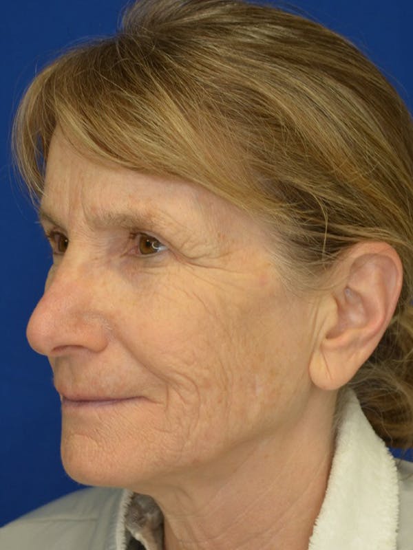 Facelift Before & After Gallery - Patient 413052 - Image 5