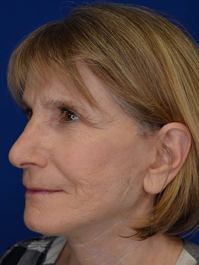 Facelift Before & After Gallery - Patient 413052 - Image 6