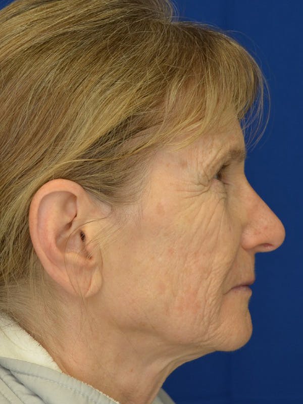 Facelift Before & After Gallery - Patient 413052 - Image 3