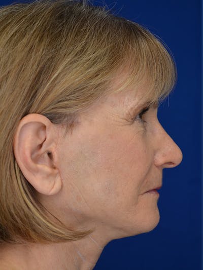 Facelift Before & After Gallery - Patient 413052 - Image 4