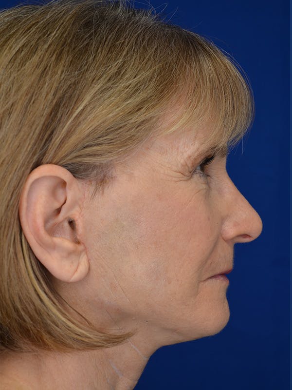 Facelift Before & After Gallery - Patient 413052 - Image 4