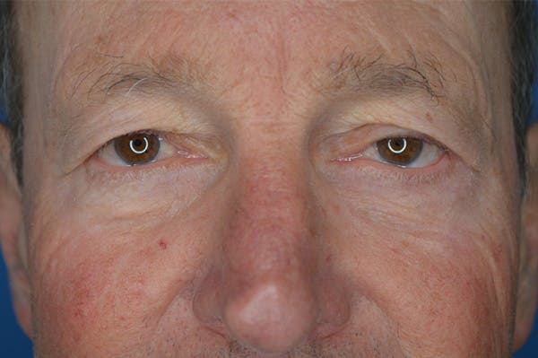 Eyelid Surgery Before & After Gallery - Patient 427474 - Image 1