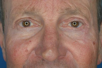 Eyelid Surgery Before & After Gallery - Patient 427474 - Image 2