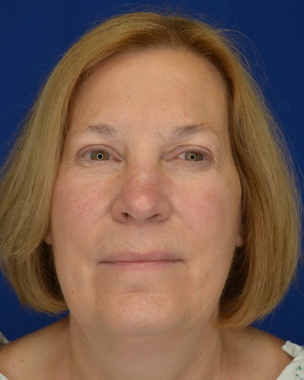 Facelift Before & After Gallery - Patient 350601 - Image 1