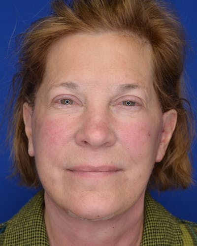Facelift Before & After Gallery - Patient 350601 - Image 2