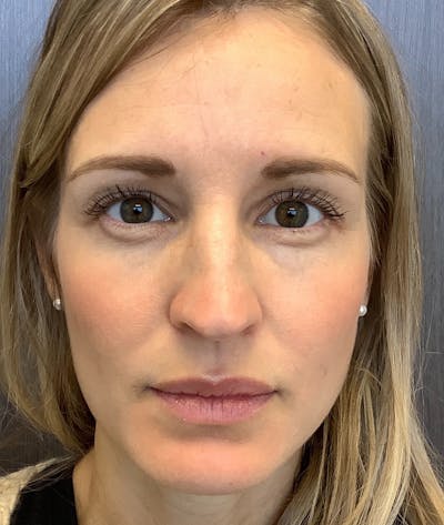 Injectables Before & After Gallery - Patient 129836 - Image 1