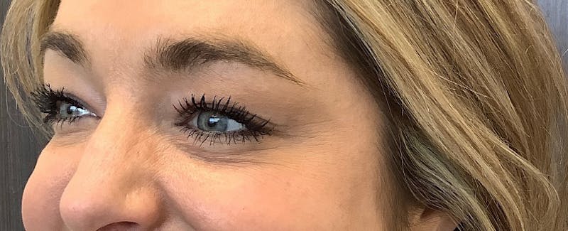 Injectables Before & After Gallery - Patient 189631 - Image 2