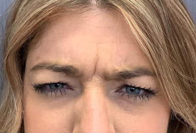 Injectables Before & After Gallery - Patient 231427 - Image 1