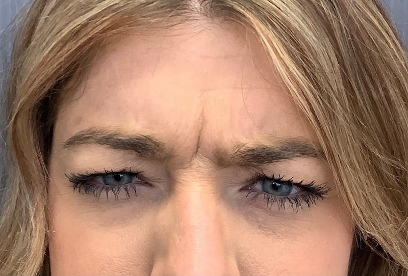 Injectables Before & After Gallery - Patient 231427 - Image 1