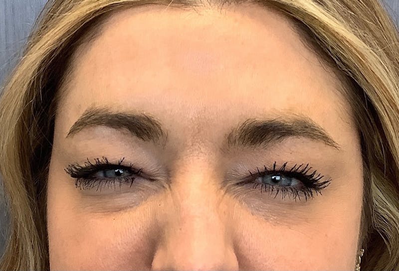 Injectables Before & After Gallery - Patient 231427 - Image 2