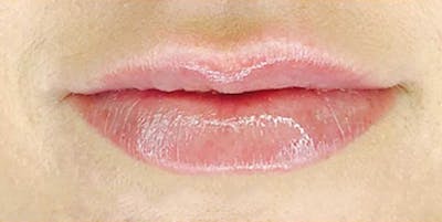 Injectables Before & After Gallery - Patient 336257 - Image 2