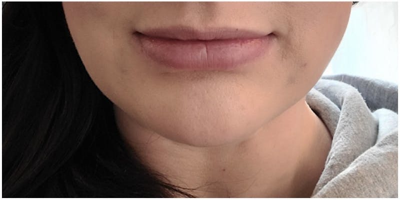 Injectables Before & After Gallery - Patient 218667 - Image 2