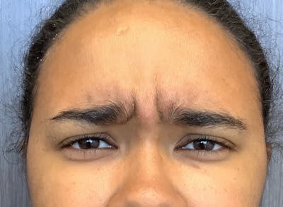 Injectables Before & After Gallery - Patient 377795 - Image 1