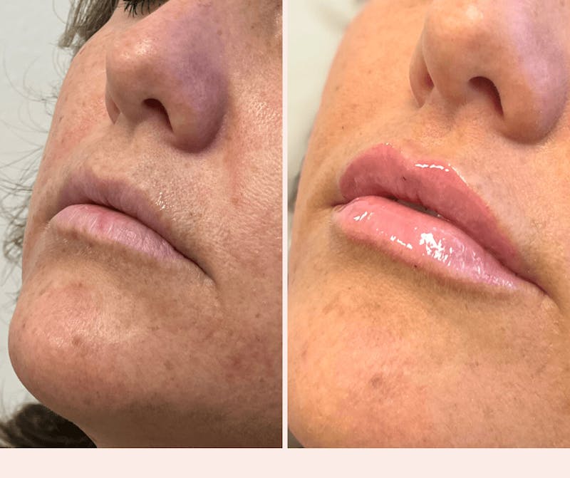 Injectables Before & After Gallery - Patient 371925 - Image 1