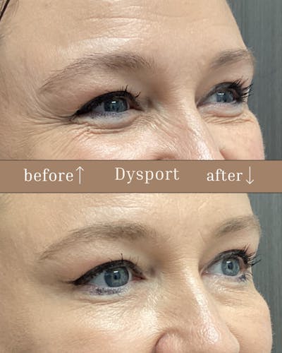 Injectables Before & After Gallery - Patient 195894 - Image 1