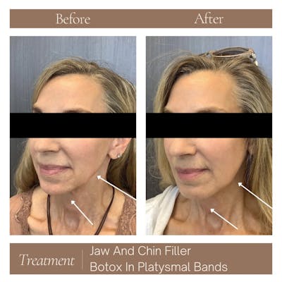 Injectables Before & After Gallery - Patient 408074 - Image 1