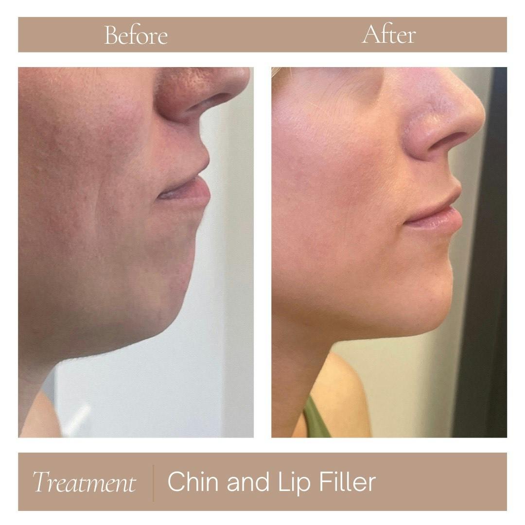 Injectables Before & After Gallery - Patient 330759 - Image 1