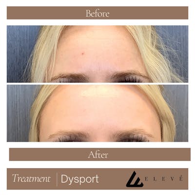 Injectables Before & After Gallery - Patient 971809 - Image 1