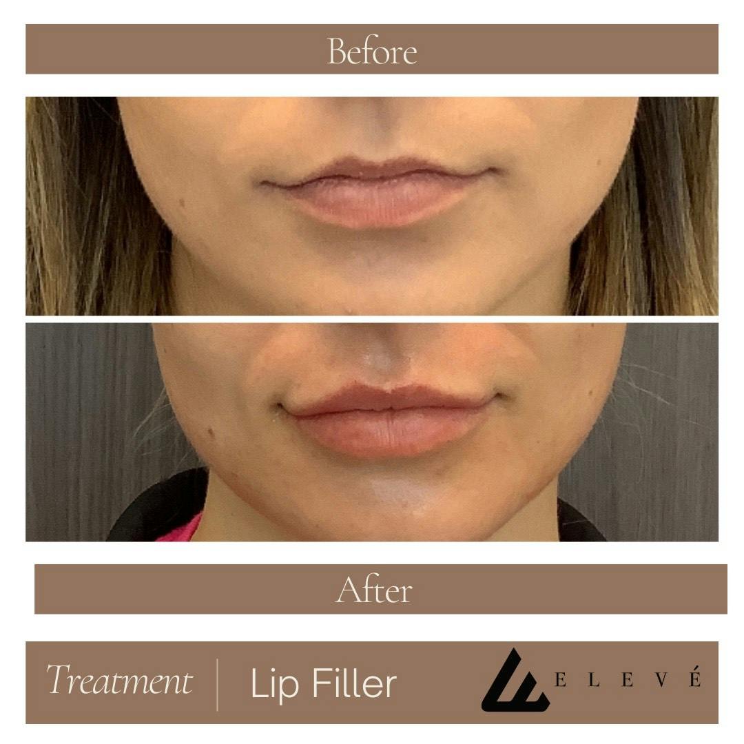 Injectables Before & After Gallery - Patient 329645 - Image 1