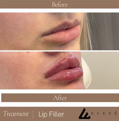 Injectables Before & After Gallery - Patient 726086 - Image 1