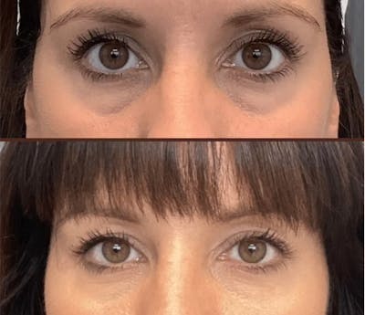 Injectables Before & After Gallery - Patient 400416 - Image 1