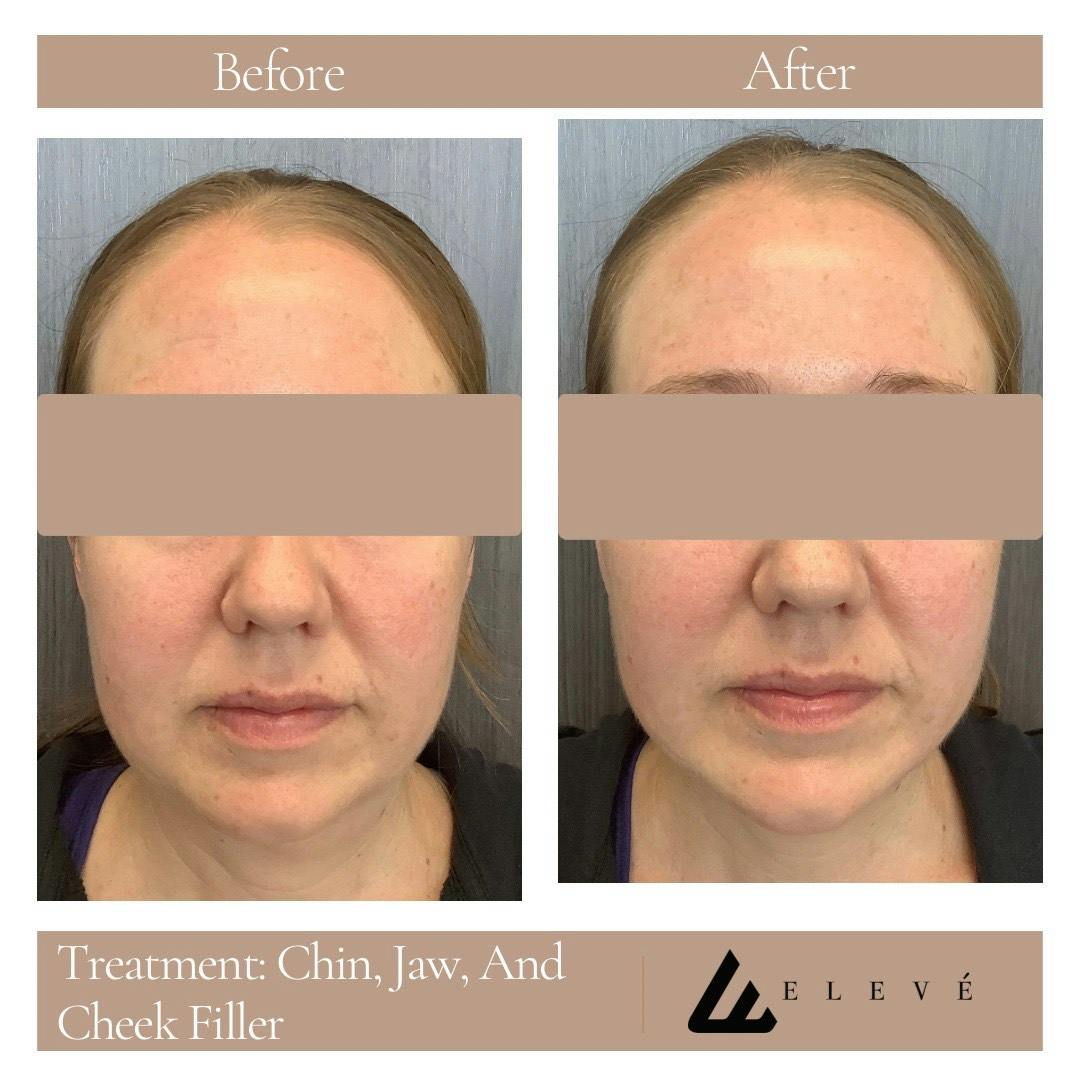 Injectables Before & After Gallery - Patient 227642 - Image 1