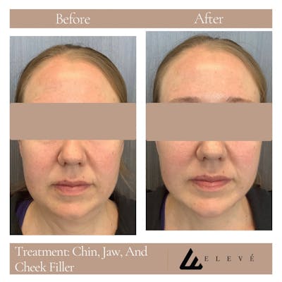 Injectables Before & After Gallery - Patient 227642 - Image 1