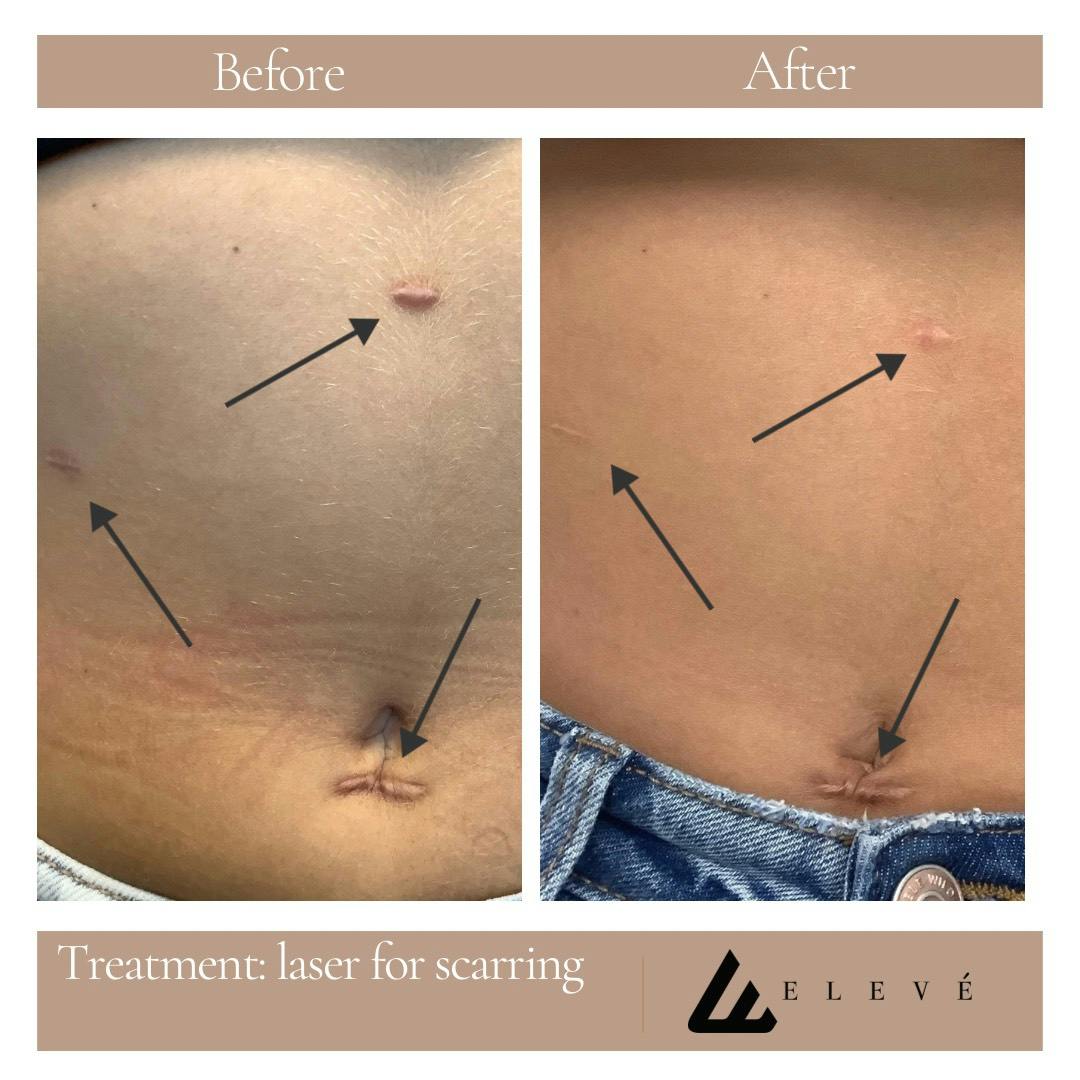 Eleve Glow Before & After Gallery - Patient 253941 - Image 1