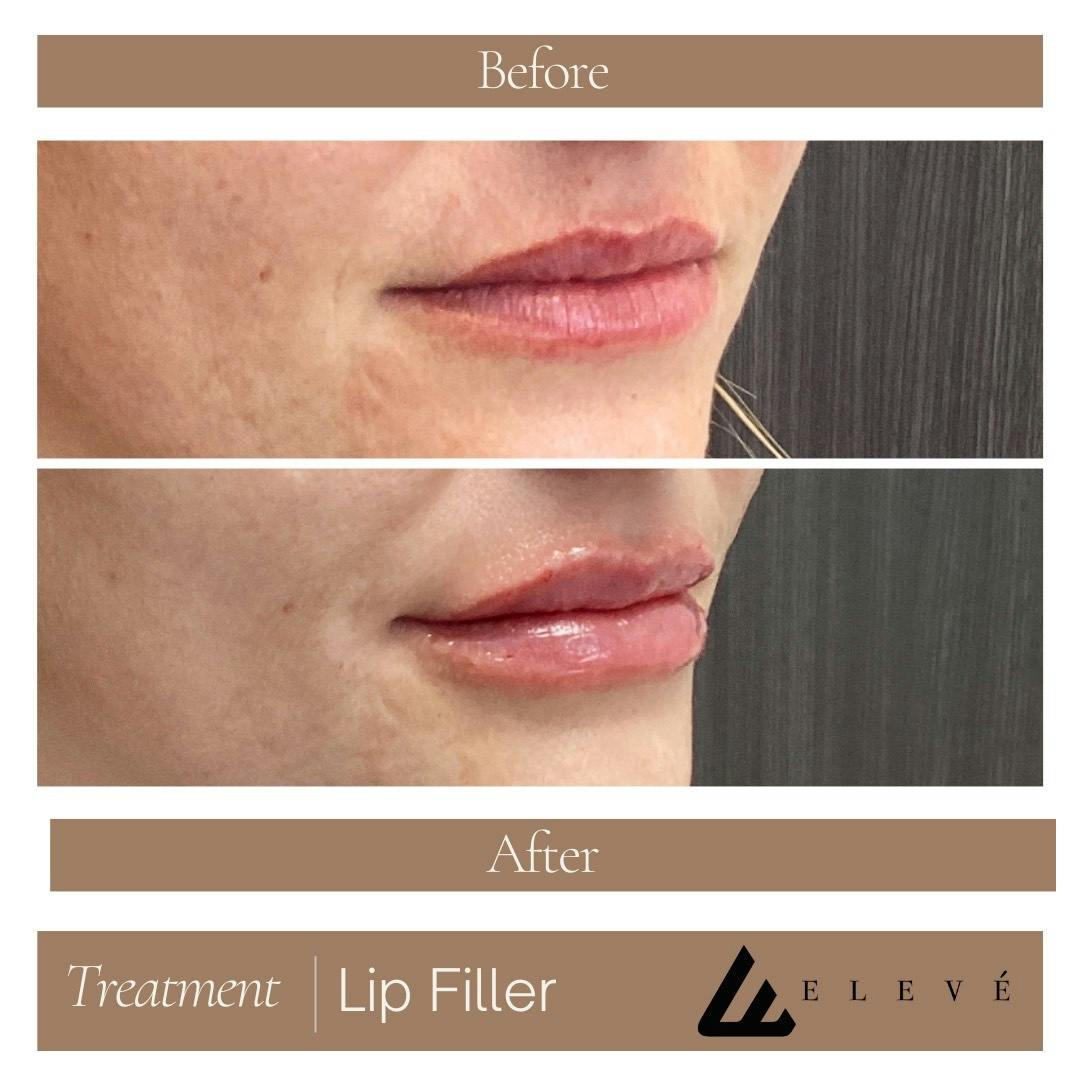 Injectables Before & After Gallery - Patient 149966 - Image 1