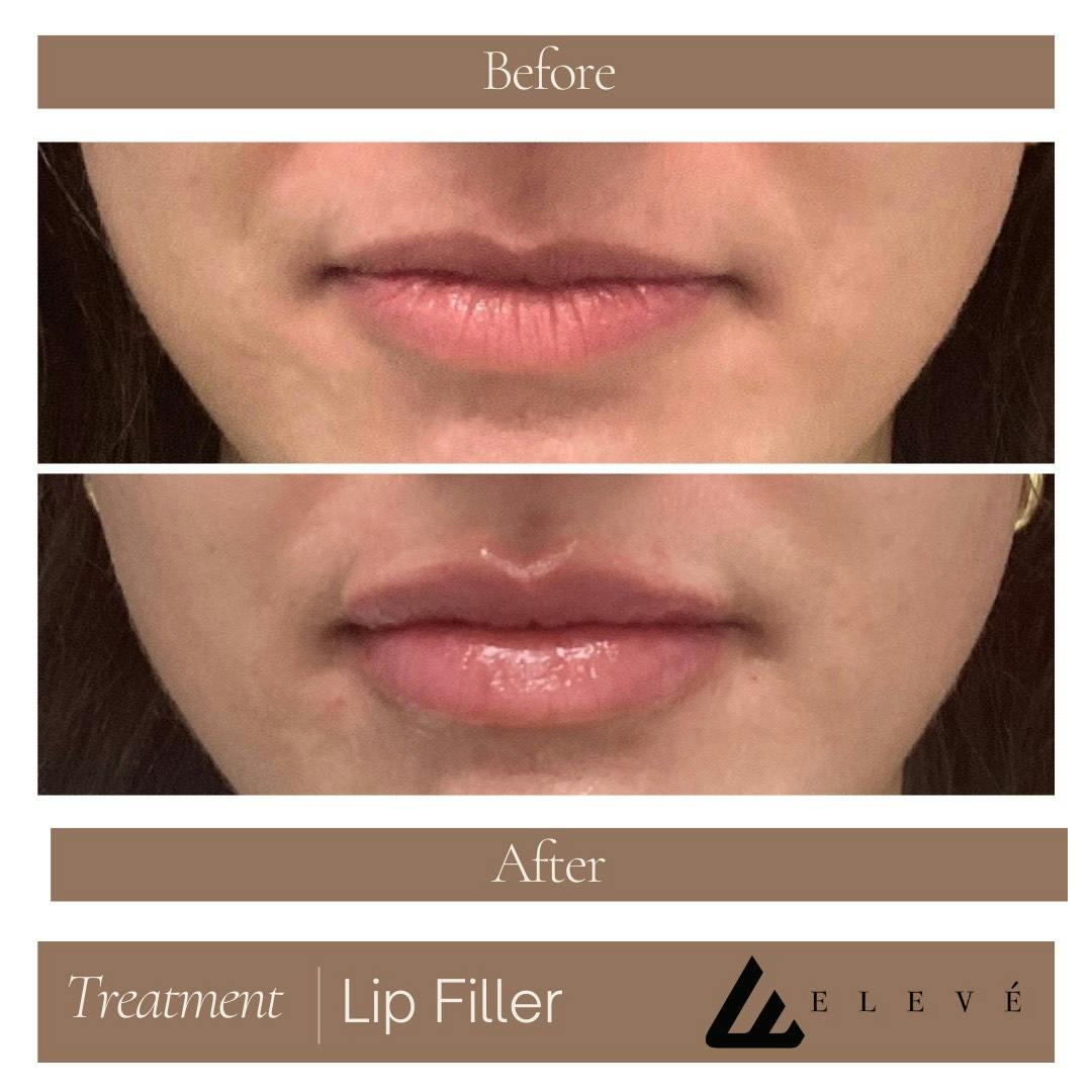 Injectables Before & After Gallery - Patient 739713 - Image 1