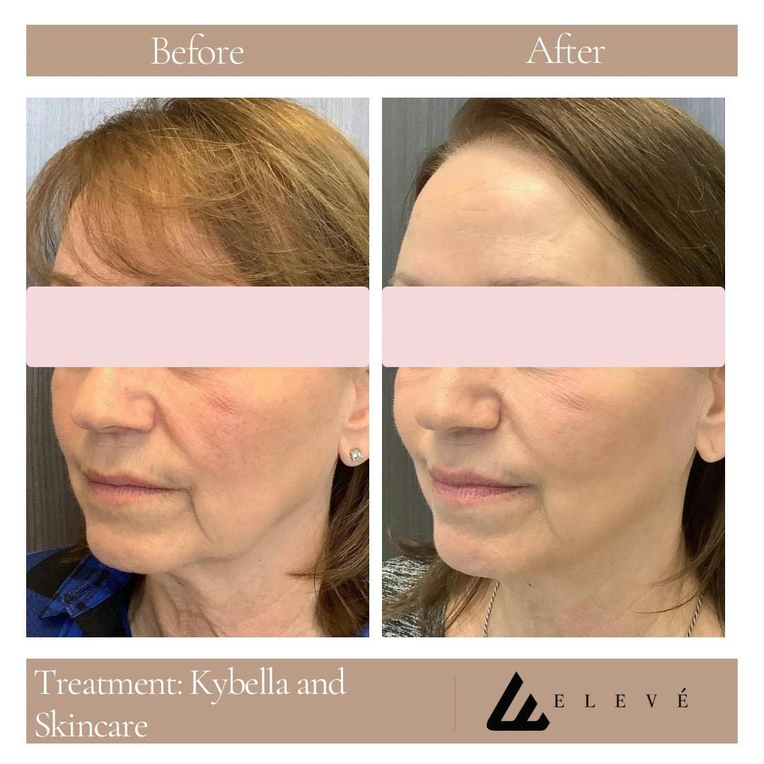 Injectables Before & After Gallery - Patient 125573 - Image 2