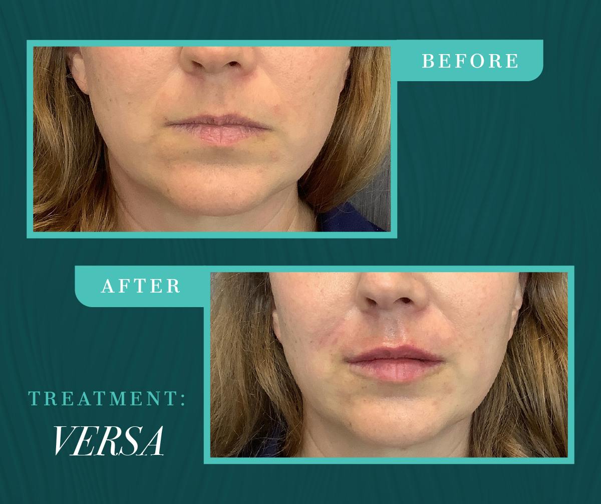 Injectables Before & After Gallery - Patient 415674 - Image 1