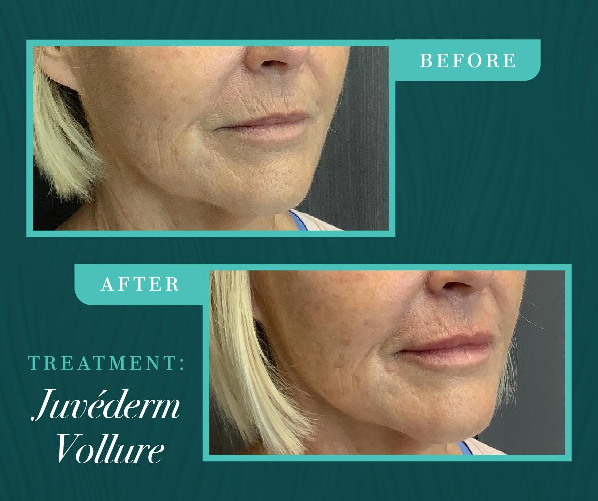 Injectables Before & After Gallery - Patient 329205 - Image 1