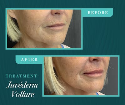 Injectables Before & After Gallery - Patient 329205 - Image 1