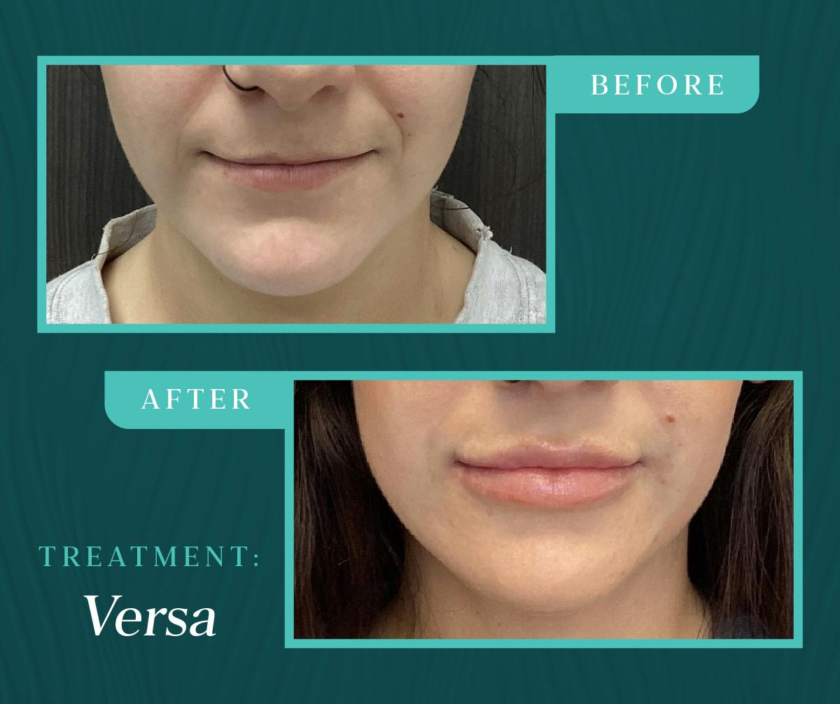 Injectables Before & After Gallery - Patient 999369 - Image 1