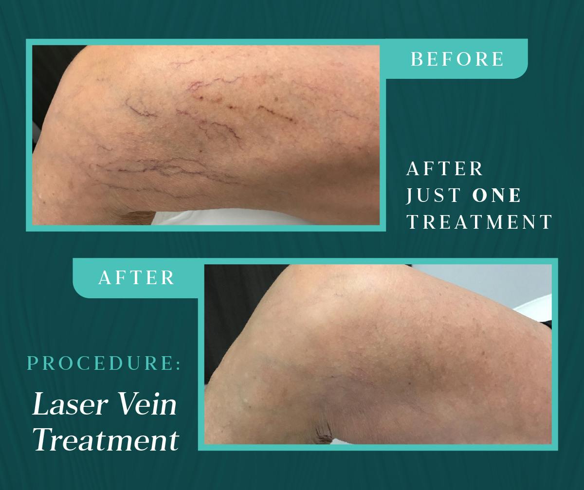 Laser Vein Treatment Before & After Gallery - Patient 413320 - Image 1