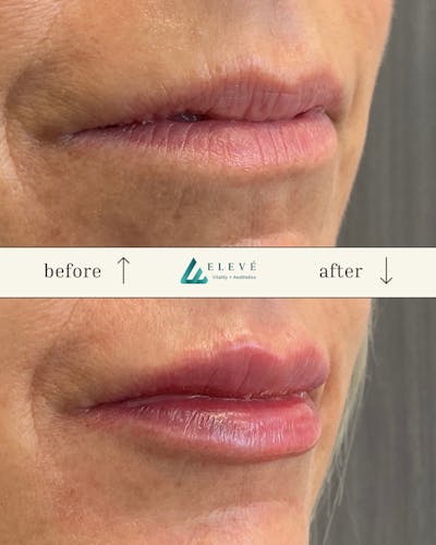 Injectables Before & After Gallery - Patient 142885 - Image 1