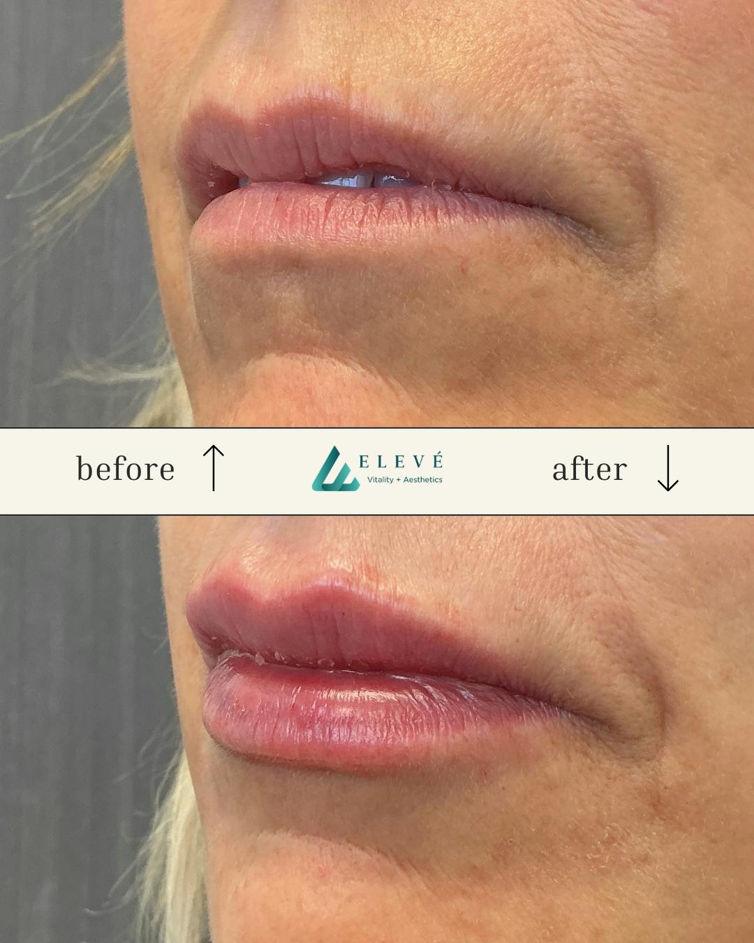 Injectables Before & After Gallery - Patient 142885 - Image 3