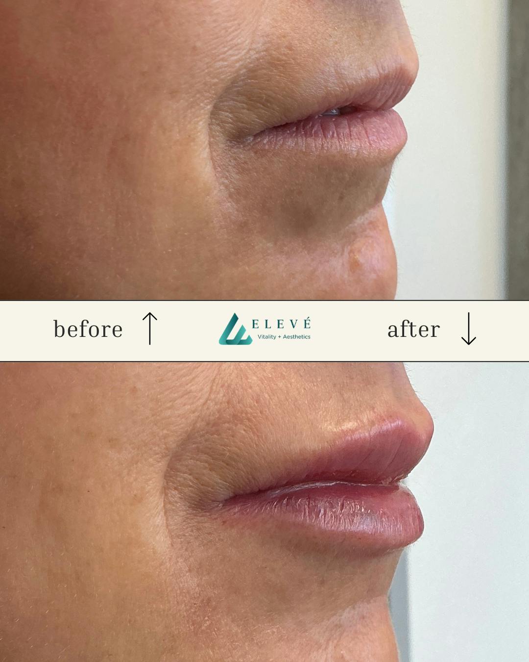 Injectables Before & After Gallery - Patient 142885 - Image 2