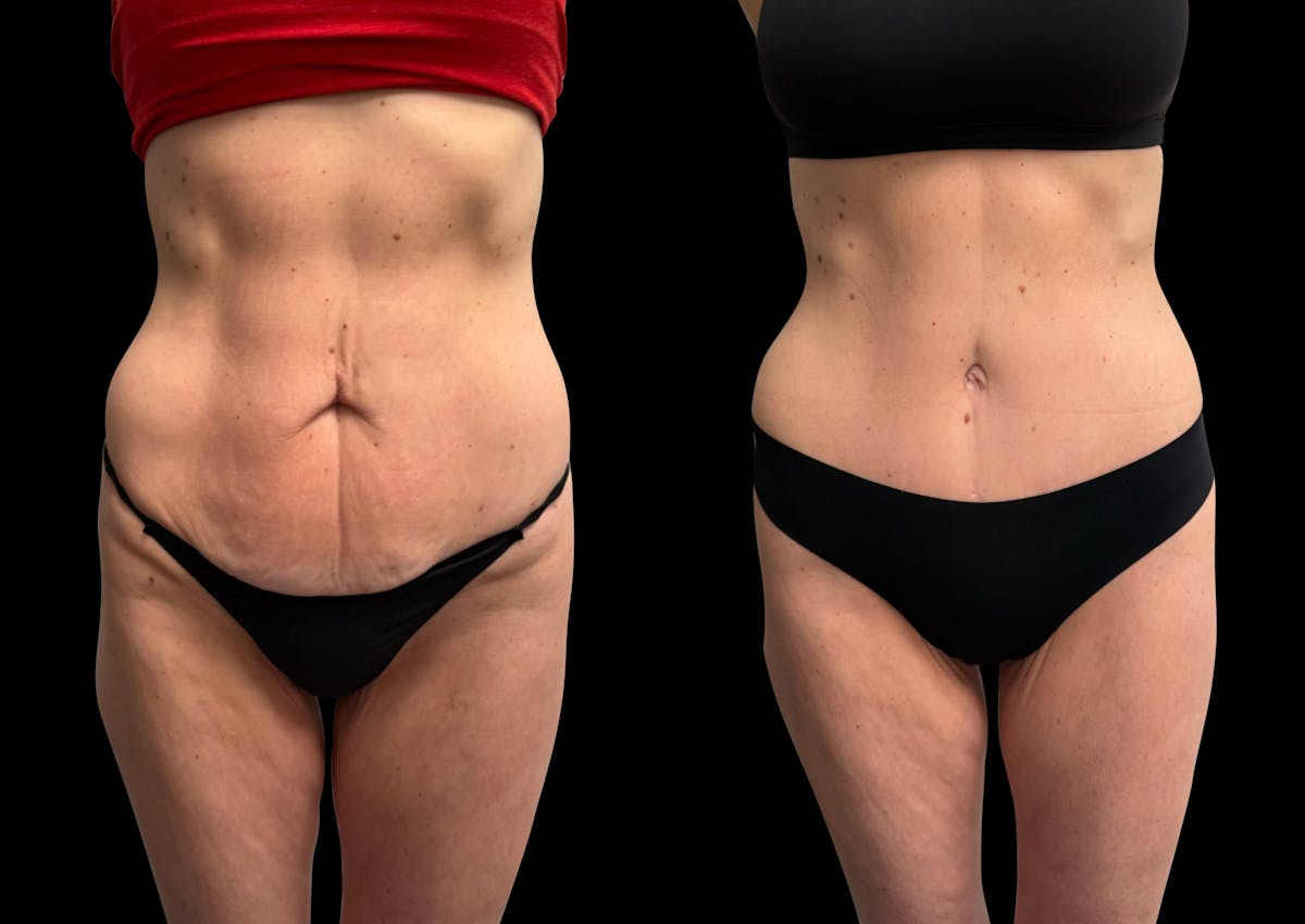 Tummy Tuck Before & After Gallery - Patient 138485 - Image 2