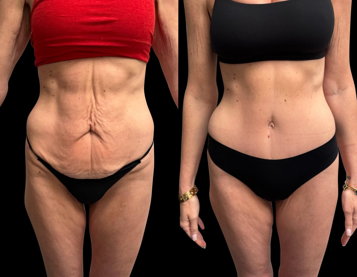 Tummy Tuck Before & After Gallery - Patient 138485 - Image 1