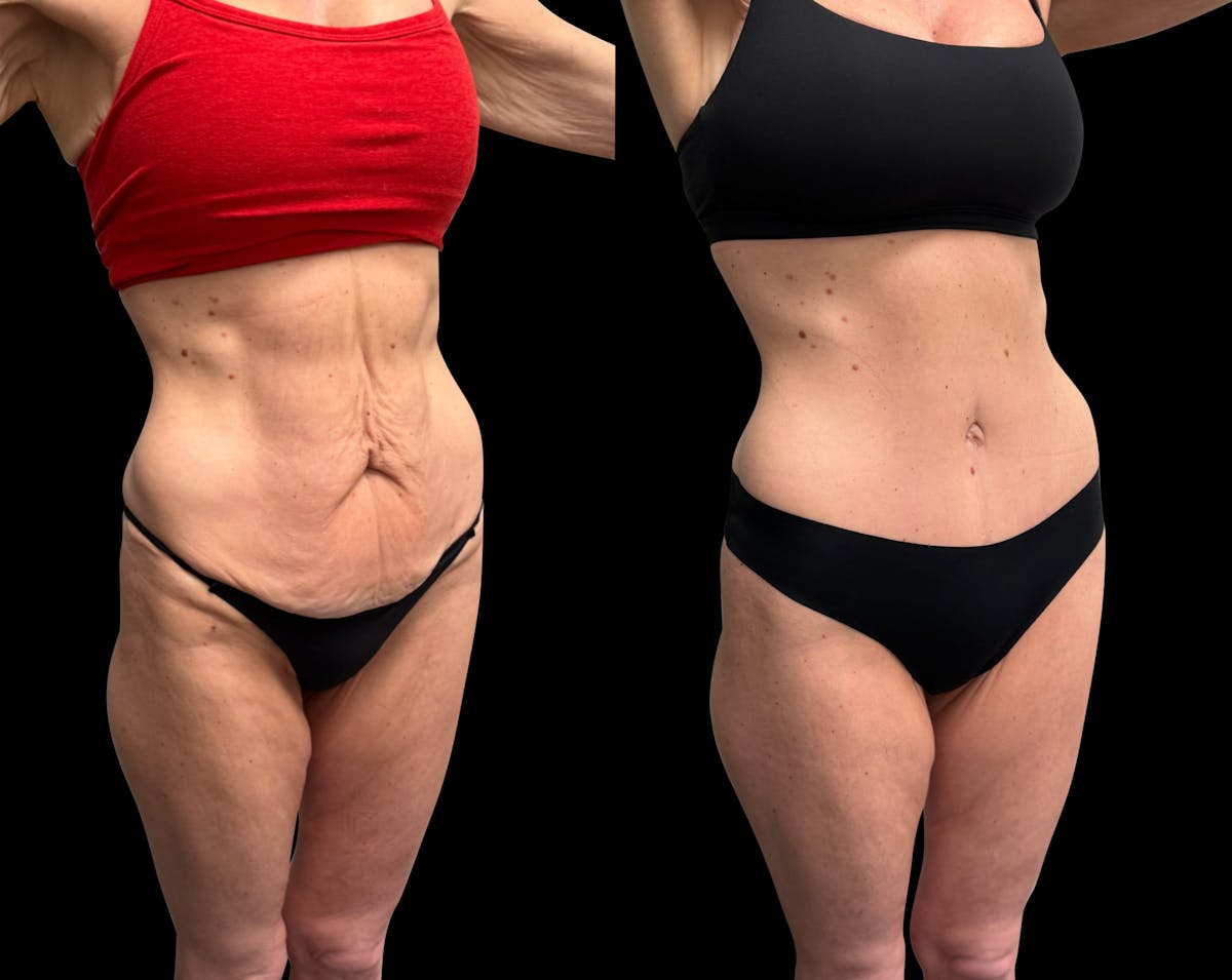 Tummy Tuck Before & After Gallery - Patient 138485 - Image 5