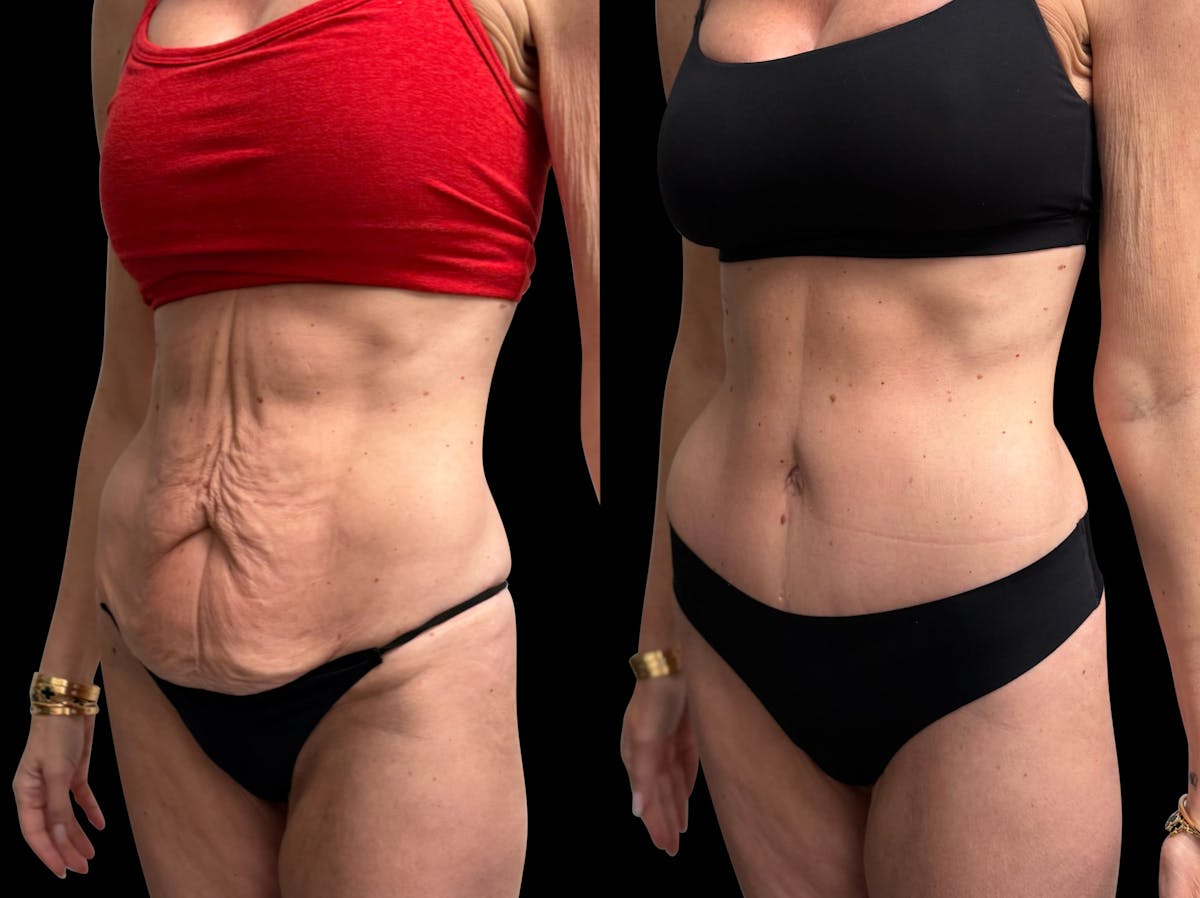 Tummy Tuck Before & After Gallery - Patient 138485 - Image 3